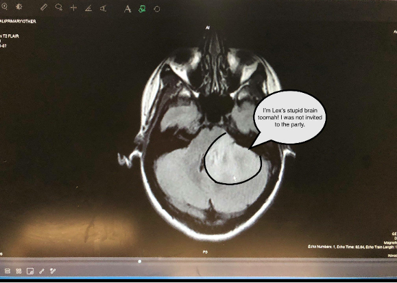 MRI scan of tumor (Nov 2018)